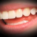 Poravnava zob z opornico in zdravljenje parodontalne bolezni